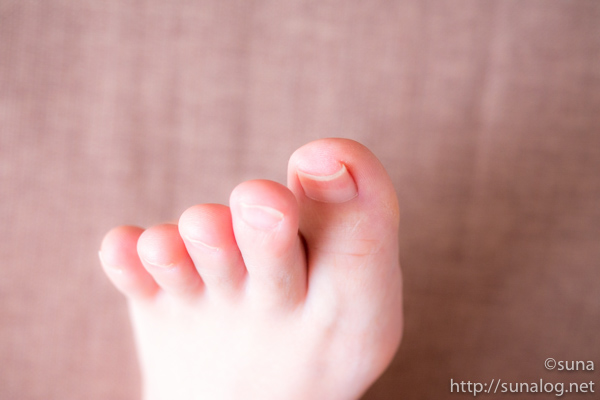 爪切り後の足の親指の巻き爪